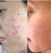 chemical peel before and after