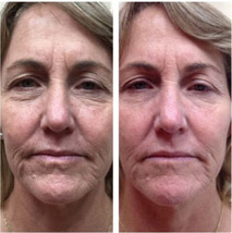 chemical peel before and after