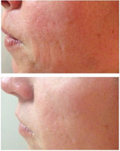 chemical peel before and after
