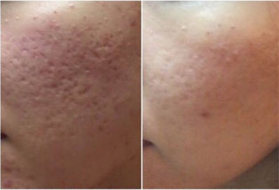 chemical peel before and after